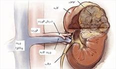 دلایل بروز بیماری مثانه عصبی/ راهکارهای درمانی بی‌اختیاری ادرار